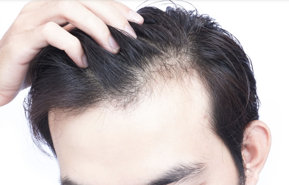 Consulta médica online para pérdida de pelo y alopecia